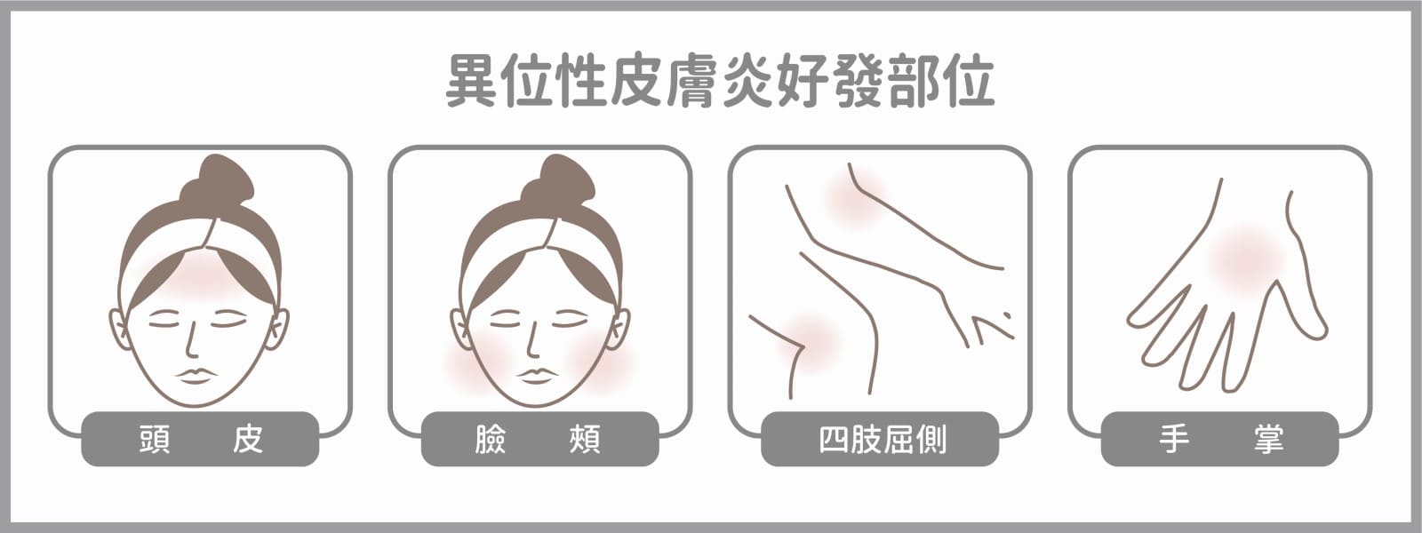 異位性皮膚炎好發部位有頭皮、臉頰、四肢屈側以及手掌