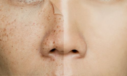 Before and after retouching freckles on an Asian woman's face because her skin has dark spots problem